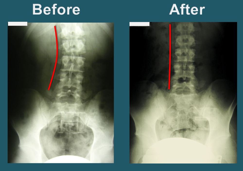 Before-treatment front and side spinal X-ray images documenting initial posture