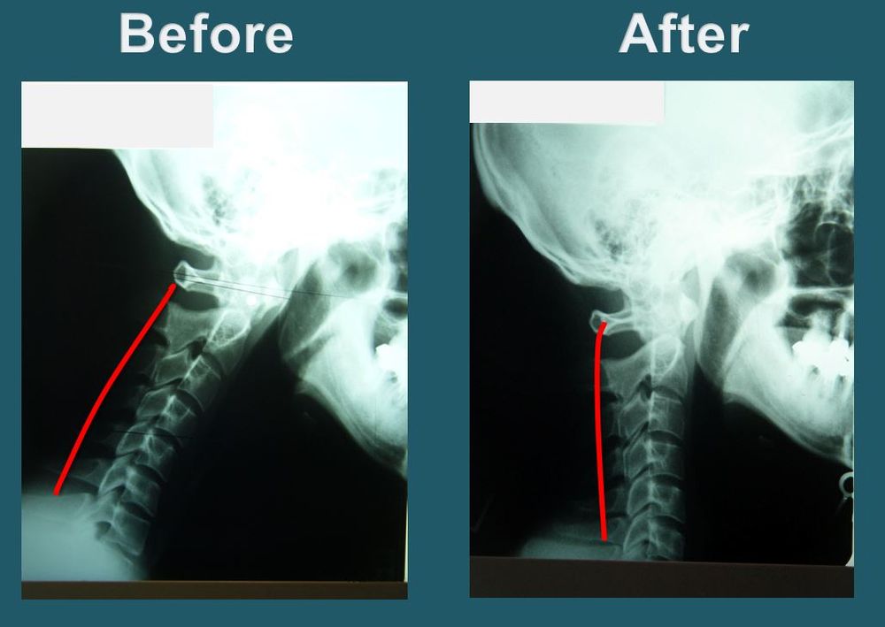 Before-treatment cervical spine X-ray showing neck alignment prior to care