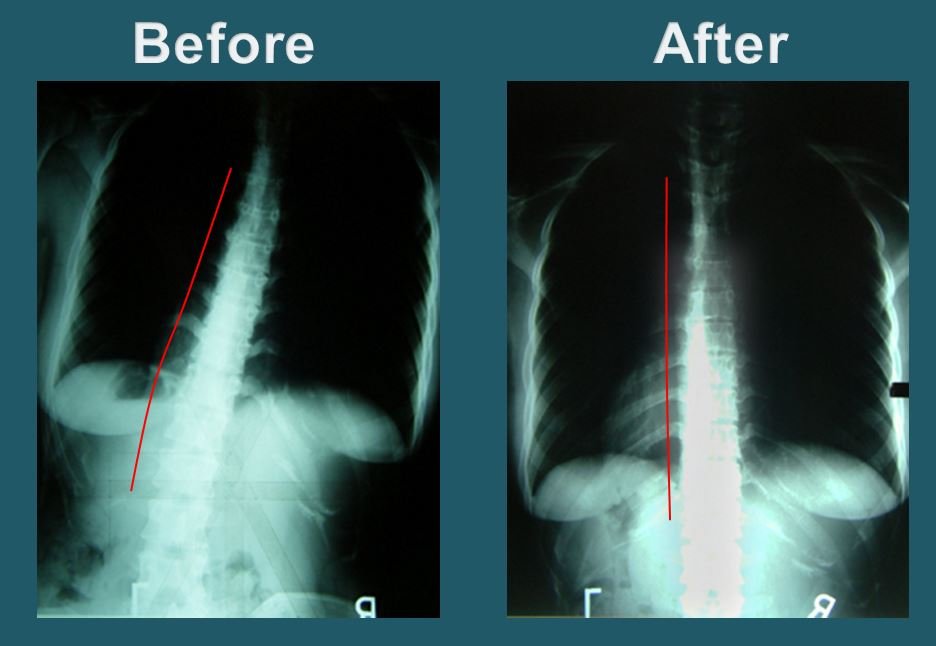 After-treatment cervical spine X-ray showing improved neck alignment