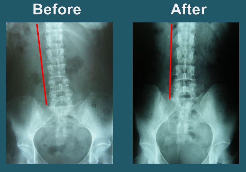 After-treatment side-view cervical X-ray showing structural change after care